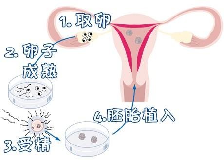 PGT三代试管